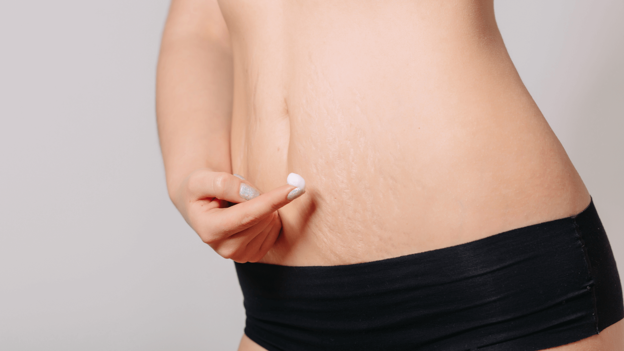 Why Losing Weight Causes Stretch Marks - Plastic Surgery Skin Clinic